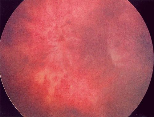 Abbildung 15: Ausgedehnte retinale Blutungen in mehreren Schichten nach Schütteltrauma