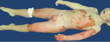 Grosflächige rote Flecken und Hautablösungen auf einem Kinderkörper.