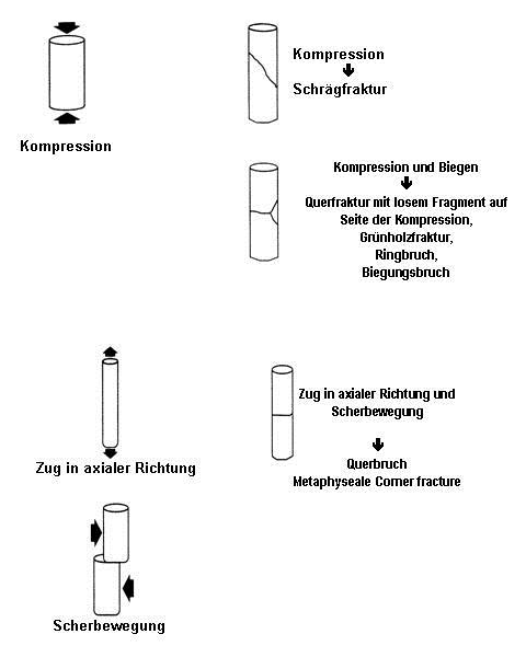 Abbildung 10: Biomechanische Aspekte bei Frakturen von Röhrenknochen Teil 1