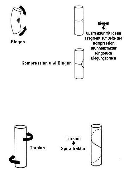 Abbildung 10: Biomechanische Aspekte bei Frakturen von Röhrenknochen Teil 2